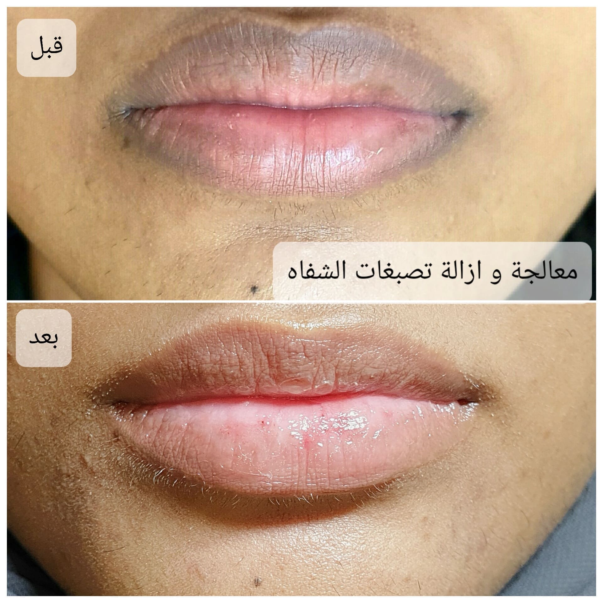 Lightening lip pigmentation