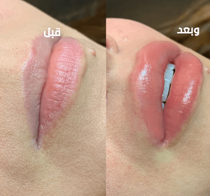 Lip Tinting